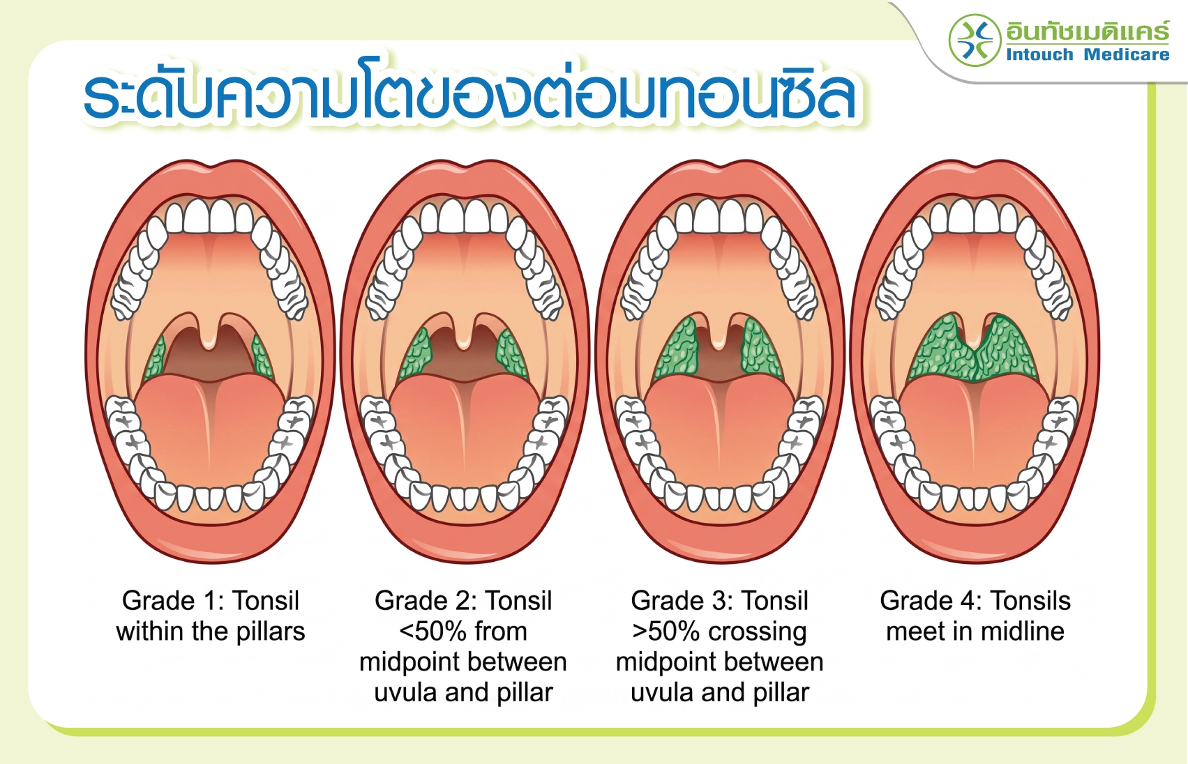 ระดับความโตของต่อมทอนซิน