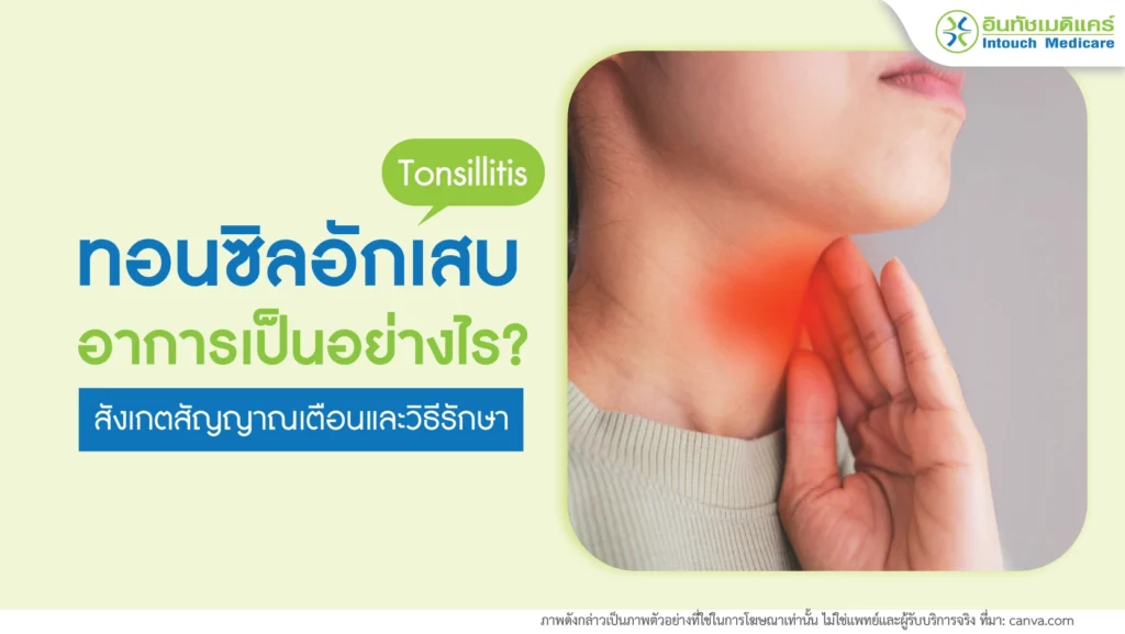 โรคทอนซิลอักเสบ
